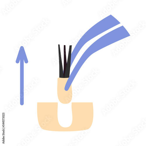 Hair transplant treatment forceps symbol. Surgical tweezers pulling out hair follicle. Alopecia medical procedure equipment tool. Hair loss diagnosis and transplantation concept. Vector illustration.