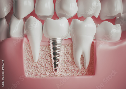 фотографія Implant next to a healthy molar - 3D rendering