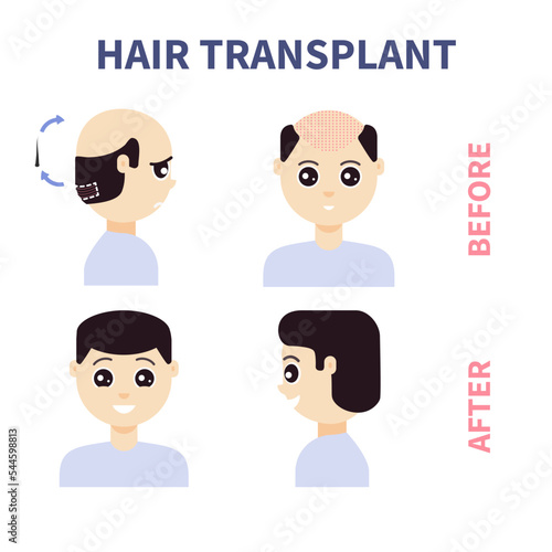 FUE hair transplant treatment of alopecia. Front and side view of a man before and after surgery. Male hair loss pattern. Medical infographics. Cartoon vector illustration.
