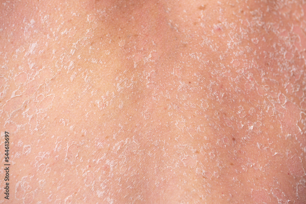 Fototapeta premium Sunburn, close-up of human skin. Flaky skin from allergies, peeling or eczema. Dry skin in need of treatment and hydration.