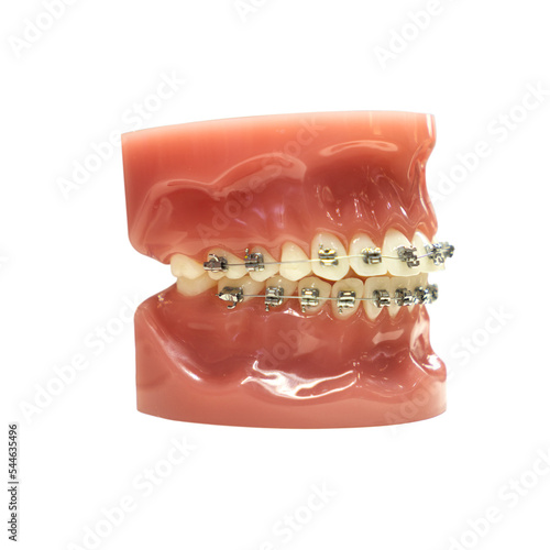 tooth model with metal wire dental braces isolated on white background