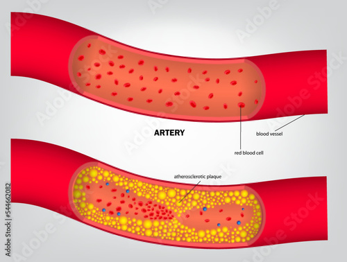 realistic type of cholesterol in artery isolated. eps vector