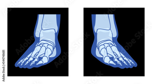 X-Ray Foot Legs Skeleton Human body Bones - malleolus, Phalanges adult people roentgen front view. Realistic flat blue color concept Vector illustration of medical anatomy isolated on black background