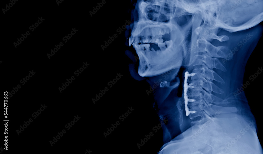 Lateral projection cervical spine xray showing anterior cervical