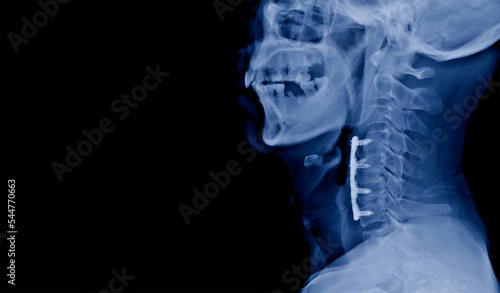 Lateral projection cervical spine x-ray showing anterior cervical discectomy and fusion or ACDF procedure. The patient has spinal cord compression and myelopathy due cervical spondylosis.