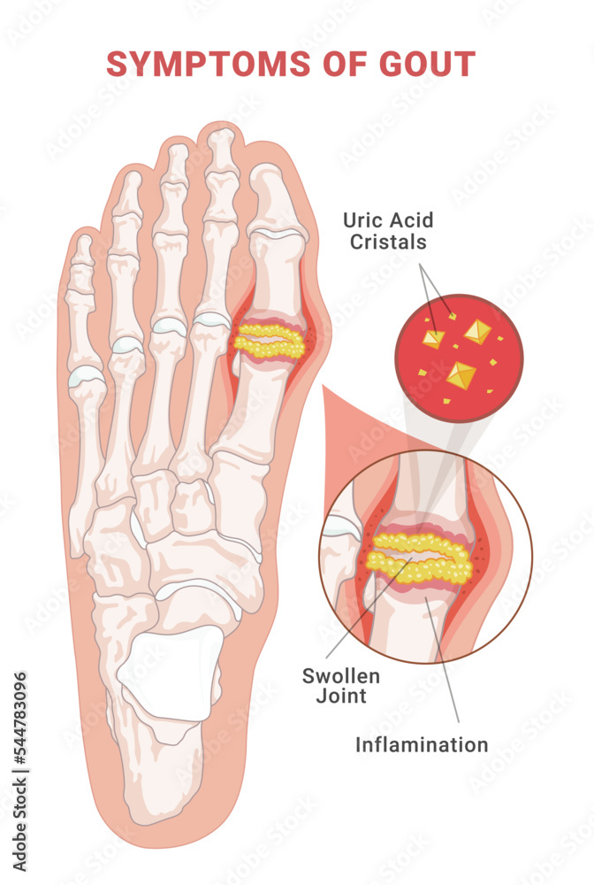 Symptoms of gout infographic scheme vector flat human foot with