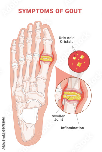 Symptoms of gout infographic scheme vector flat human foot with crystallization of uric acid