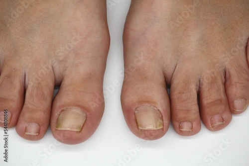 Big toe nail of a person suffering from onychomycosis a fungal infection photo