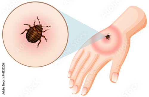 Bed bug bites sting on skin