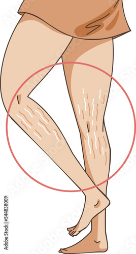 stretch marks on the leg skin