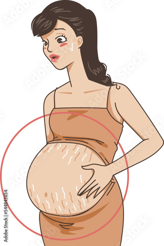 Pregnant women with stretch marks on the stomach