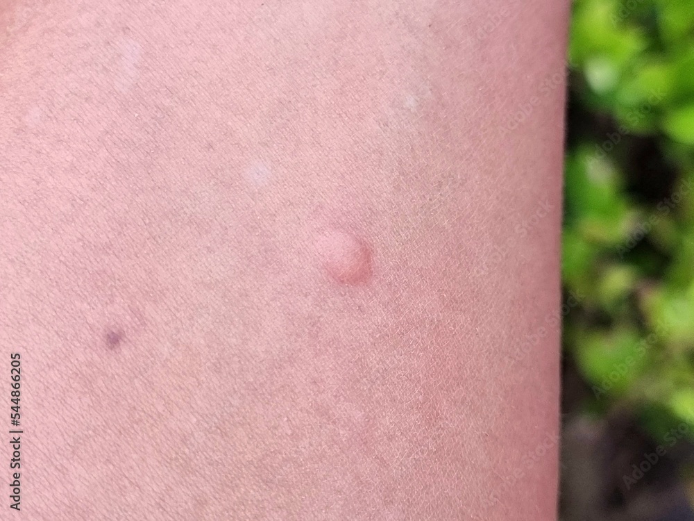 Fototapeta premium A mosquito bites a blister on the arm.