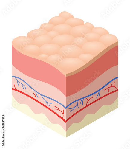 Skincare medical concept. Problems in cross-section of human skin horizontal layers structure. Anatomy illustrative model unhealthly layer of skin