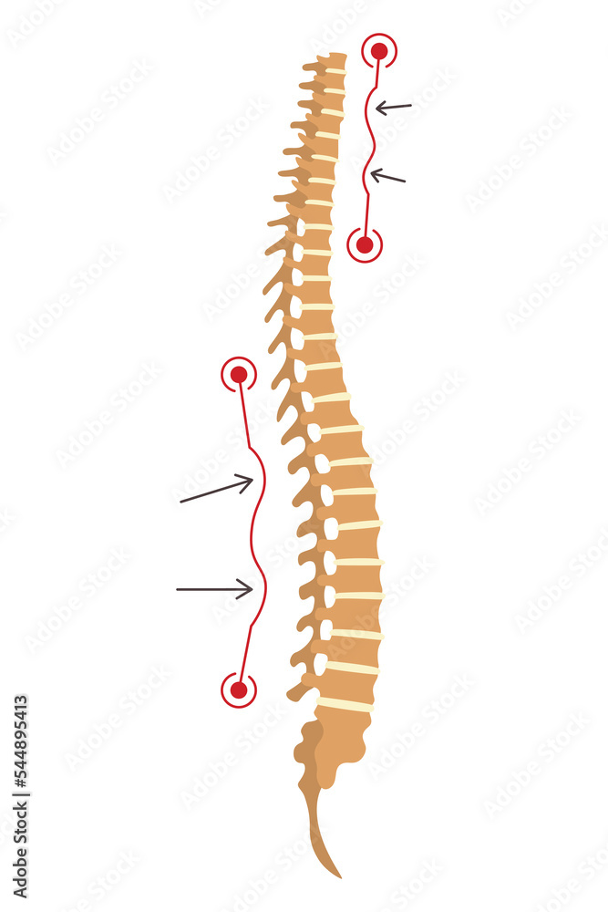 Spinal deformity. Symbol of spine curvatures or unhealthy backbones. Human spine anatomy, curved spine. Diagram with marked section. Body posture defect Spinal deformity. Symbol of spine curvatures or unhealthy backbones. Human spine anatomy, curved spine. Diagram with marked section. Body posture defect