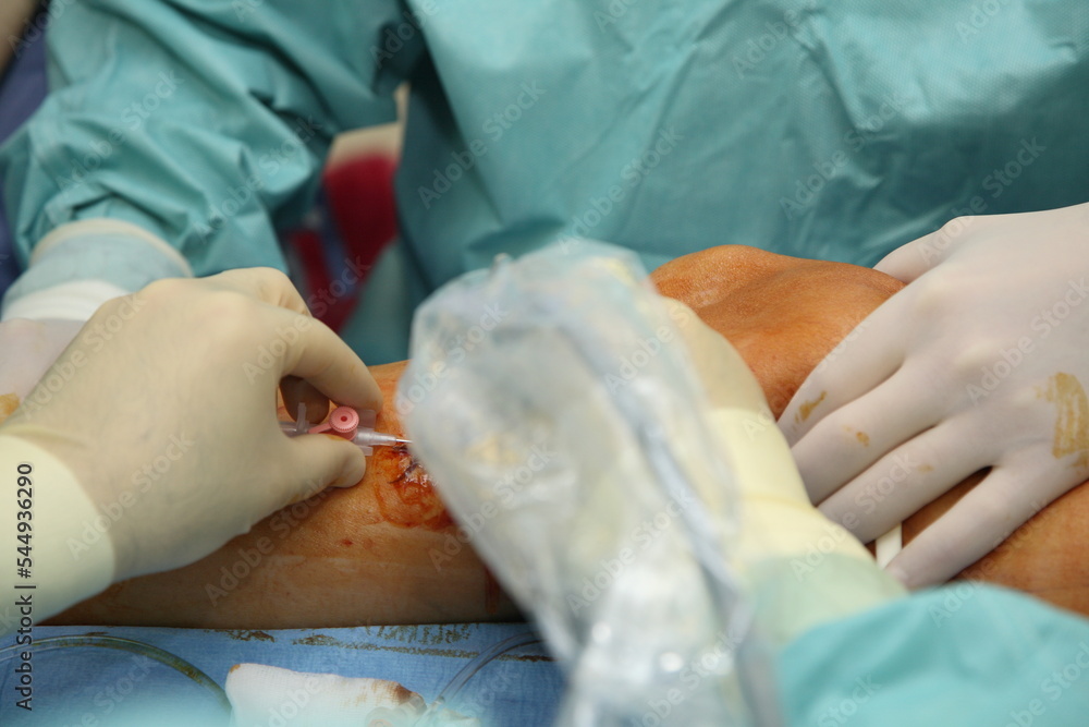 Naklejka premium Preparing the patient for phlebectomy surgery. Surgical field marking. Varicose veins surgery act, superficial veins problems, swollen skin, step by step 