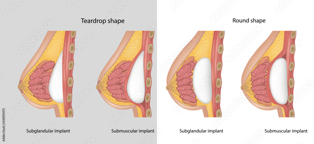 Subglandular and Submuscular Breast Implants. Breast implant
