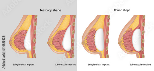 Subglandular and Submuscular Breast Implants. Breast implant shapes Teardrop shape and Round shape. Breast implant types.