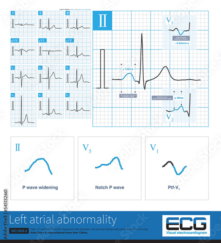 In clinic, mitral stenosis is a common organic heart disease that leads to left atrium abnormality in ECG. The duration of sinus P wave widens by more than 120ms.
