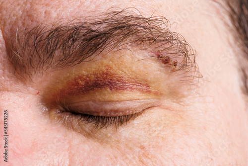 close view of a bruise near the eye, the face of a man with a hematoma