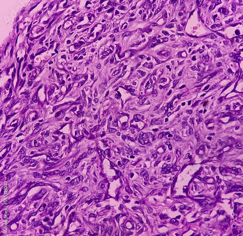 Prepatellar region histology: Chronic bursitis. light microscopic image show soft tissue, tissue dense infiltration of polymorphs, lymphocytes and histiocytes with fibrosis. photo