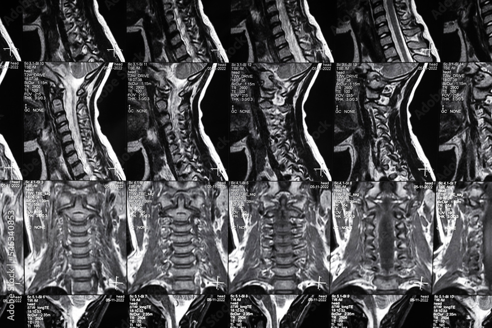 High resolution MRI scan of cervical spine. Real spine MRI scan. Stock Photo Adobe Stock