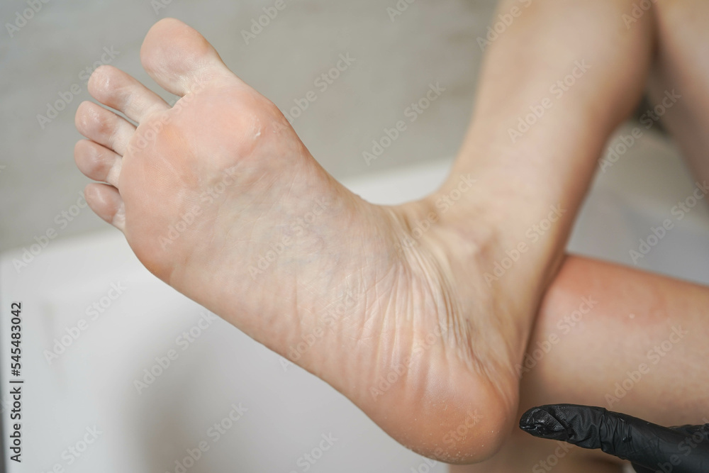 Pedicure at home. Acid pedicure. Foot close-up.