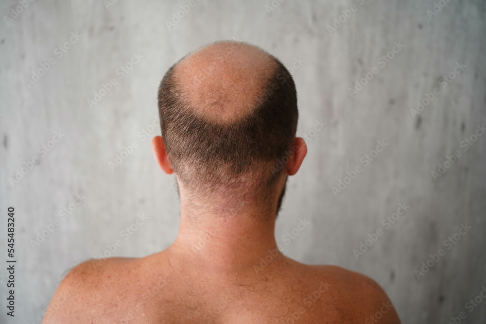 Naklejka premium The problem of baldness, a bald head of a man of European appearance, combing a bald head with a comb on a light gray background