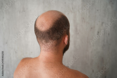 The problem of baldness, a bald head of a man of European appearance, combing a bald head with a comb on a light gray background