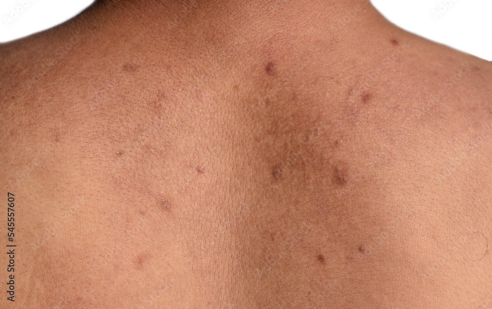 Black spots and scars on the back Black spots and scars on the back
