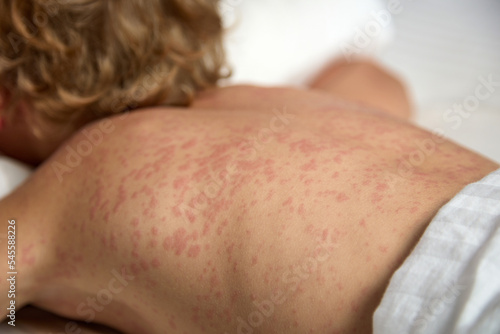 Itchy red spots strewn the entire back of a sick child. A small child lies in bed on his stomach, more rubella photo