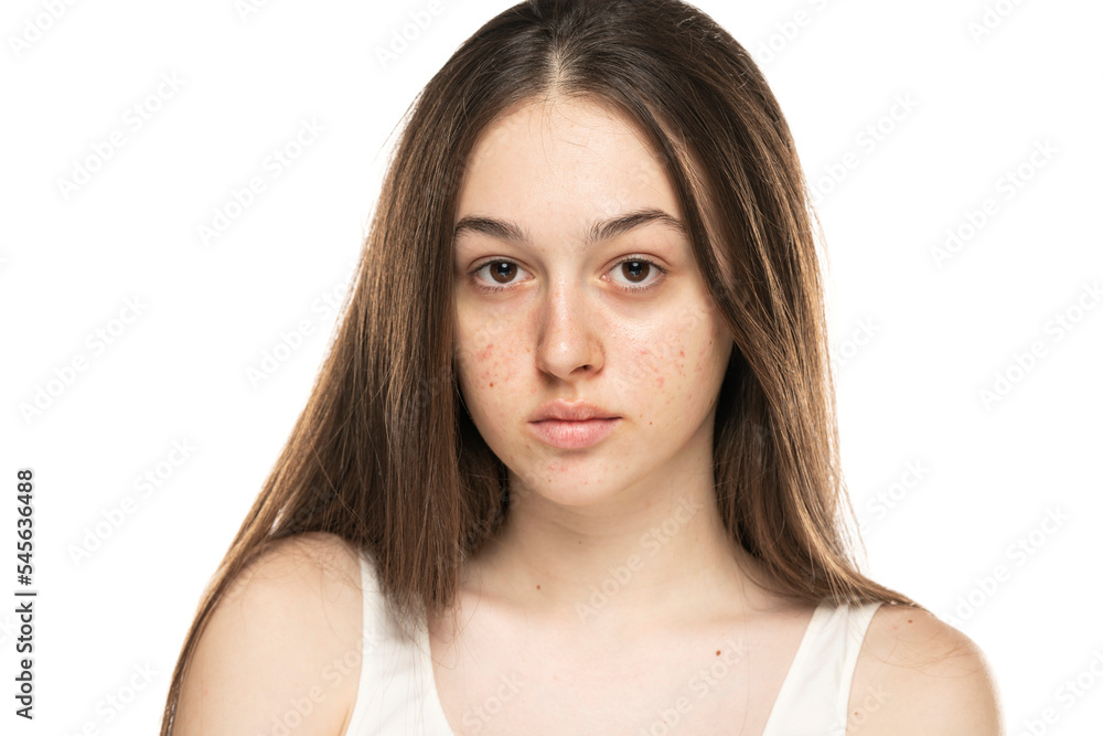 beautiful young women with problemati skin. beautiful young women with problemati skin.