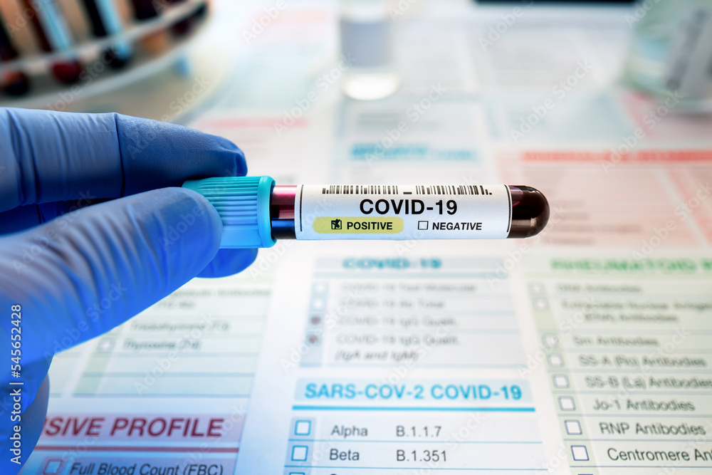 Doctor holding tube of blood sample in the laboratory identified with Positive COVID-19 or Coronavirus. Technican holding blood sample with presence positive to covid or coronavirus over requisition f