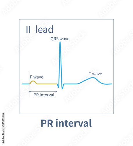 The PR interval of ECG refers to the time from the starting point of P wave to the starting point of QRS wave, which is the time when the electrical impulse conducts in the conduction system.