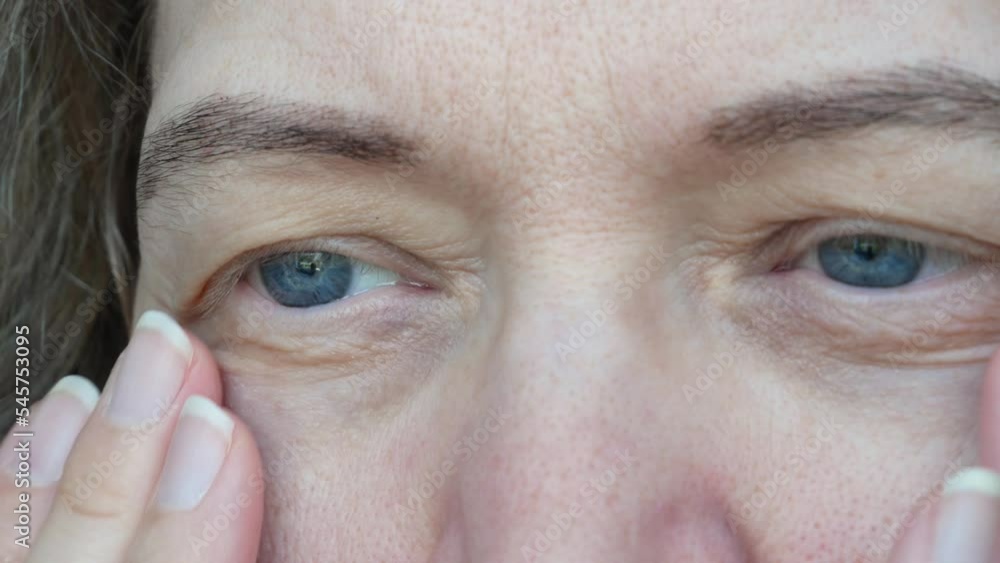 middle aged female's eye with drooping eyelid. Ptosis is a drooping of