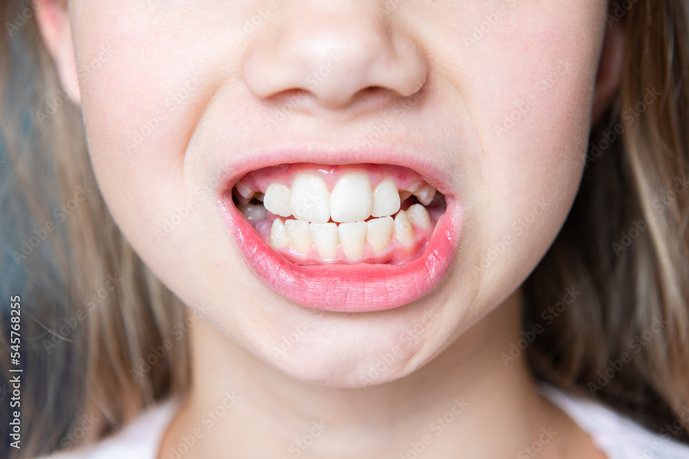 Child has crooked teeth. The concept of crowning of molars Child has crooked teeth. The concept of crowning of molars
