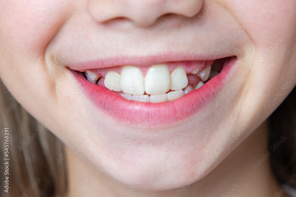 Child smiles and shows jagged teeth. Dental medicine and healthcare Child smiles and shows jagged teeth. Dental medicine and healthcare