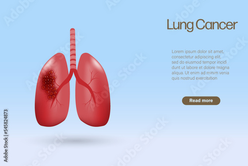 Lung cancer organ with tumor. World cancer awareness. 3D Realistic vector.