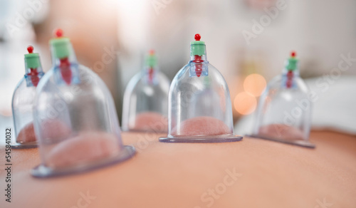 Obraz na plátně Cupping therapy, asian physiotherapy and massage spa for zen spiritual health healing, person with back pain and stress relief