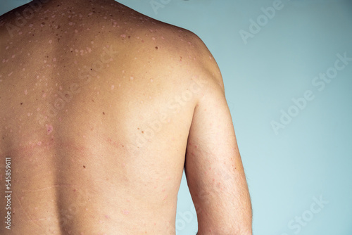 Close-up of red inflamed flaky itchy skin of bare back with blemishes of unrecognizable man suffering from psoriasis.
