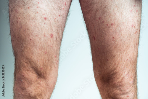 Close-up of bare legs of man showing inflamed scaly flaky skin suffering from chronic psoriasis on blue background.