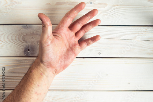 Top view of unrecognizable man suffering from psoriasis, showing thick scaly clusters, rash on skin of palm, fingers.