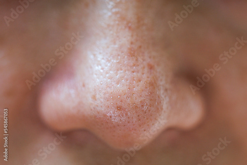 close up a small pimple on a woman's nose