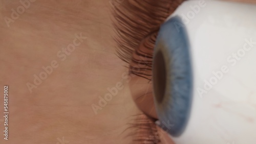Render Keratoconus eye. Curvature of the cornea in the form of a cone, blurred vision, astigmatism, myopia. Macro close-up of curvature of keratoconus. High quality 3d illustration