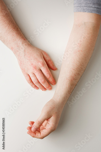 Male hands on white table with red spots on skin. Allergic reaction, skin problems, dermatology. Wrong diet, side effect from taking meds