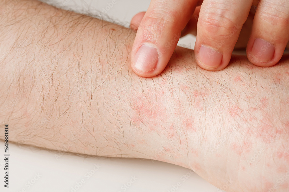 Hands with allergy reaction from taking medicines. By-effect, dermatology. Patient points on red spots on skin with forefinger, closeup Hands with allergy reaction from taking medicines. By-effect, dermatology. Patient points on red spots on skin with forefinger, closeup