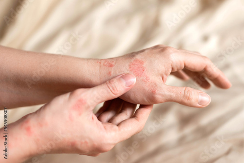 Itching on hands with redness rash. Cause of itchy skin include dermatitis (eczema), dry skin, burned, food,drug allergies, insect bites. Health care concept.