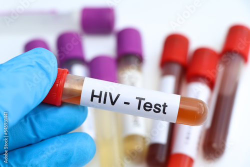 HIV test to look for abnormalities from blood