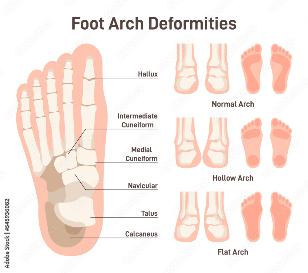 Foot anatomy scheme. Hollow and flat arch deformities. Diagram of ...