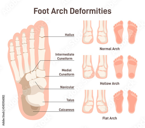 Foot anatomy scheme. Hollow and flat arch deformities. Diagram of normal