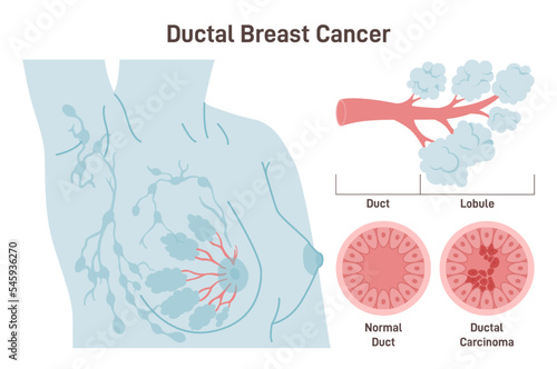 Ductal carcinoma. Detailed breast medical anatomy with lactiferous